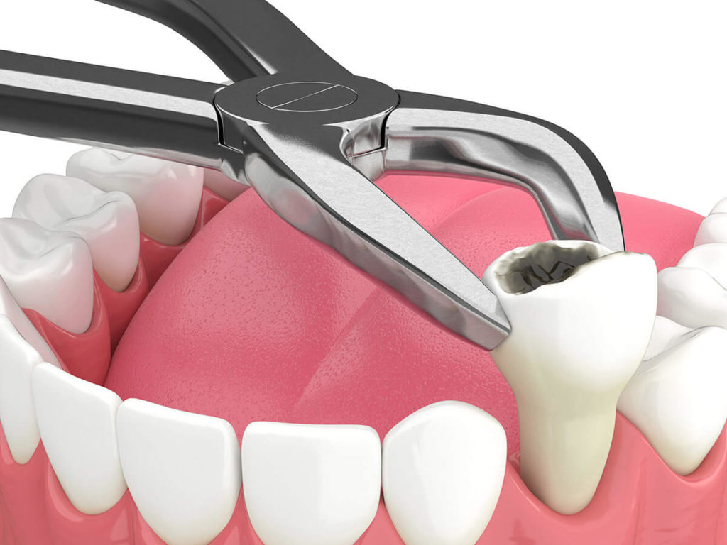 tooth extraction graphic