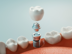 graphic of a dental implant being placed