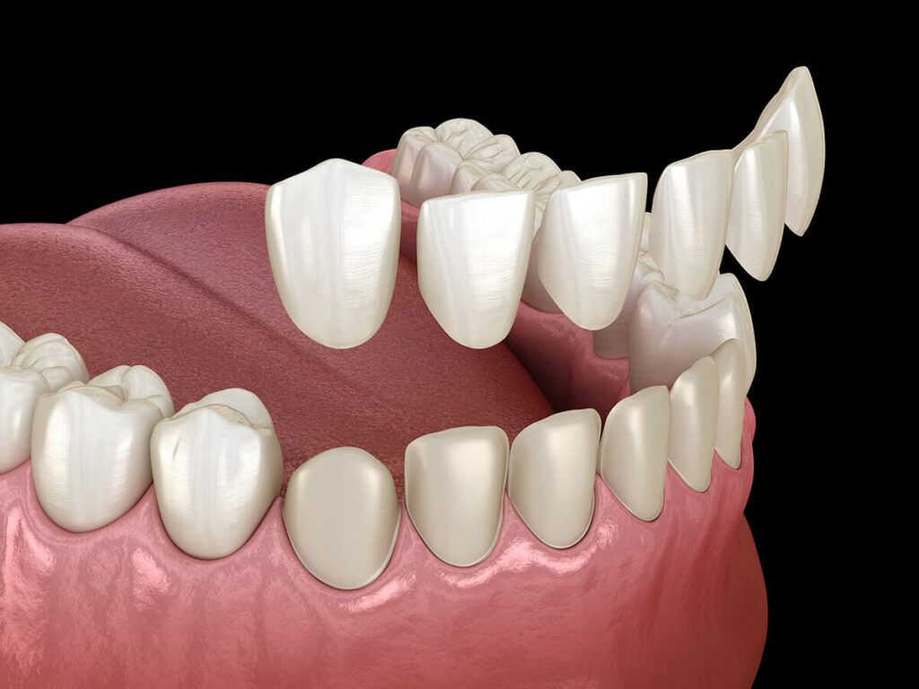 dental veneer graphic