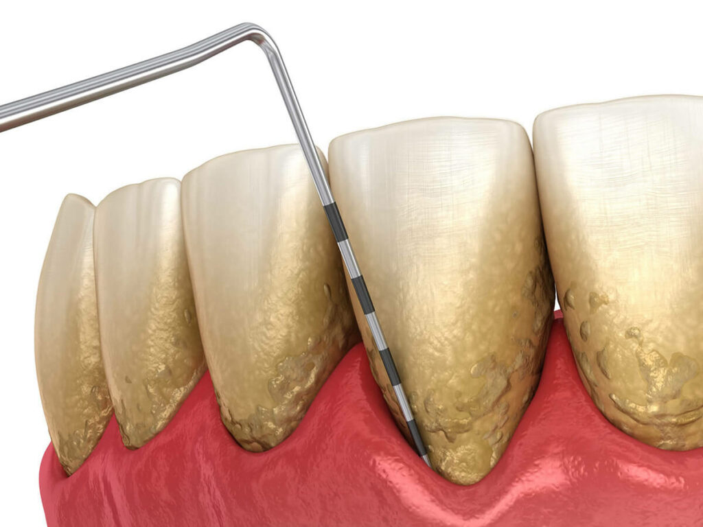 gums measurement graphic