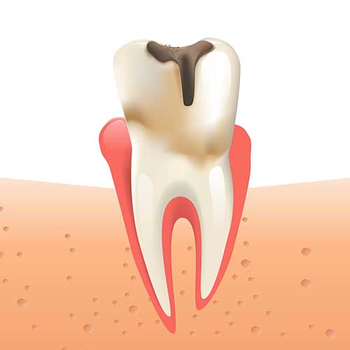 tooth decay treatment graphic
