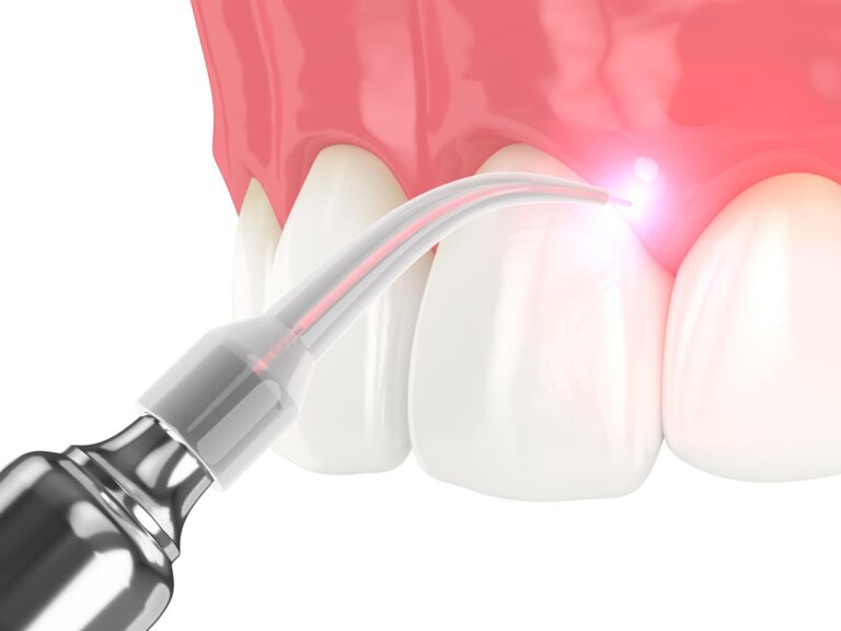 Dental Soft-Tissue Laser in Orange, CA at Orange Grove Family Dentistry