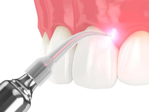 Soft-Tissue Dental Laser in Orange, CA at Orange Grove Family Dentistry